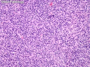 Malignant Peripheral Nerve Sheath Tumor