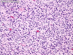 Malignant Peripheral Nerve Sheath Tumor