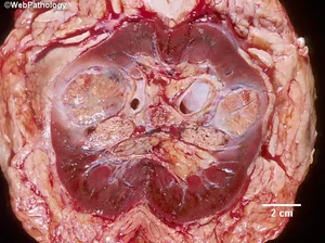 Renal Cell Carcinoma Gross Morphology