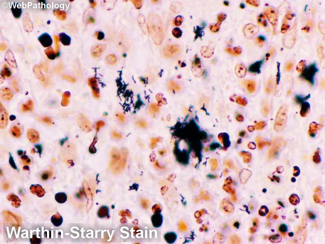 Cat-Scratch Disease: Warthin-Starry Stain