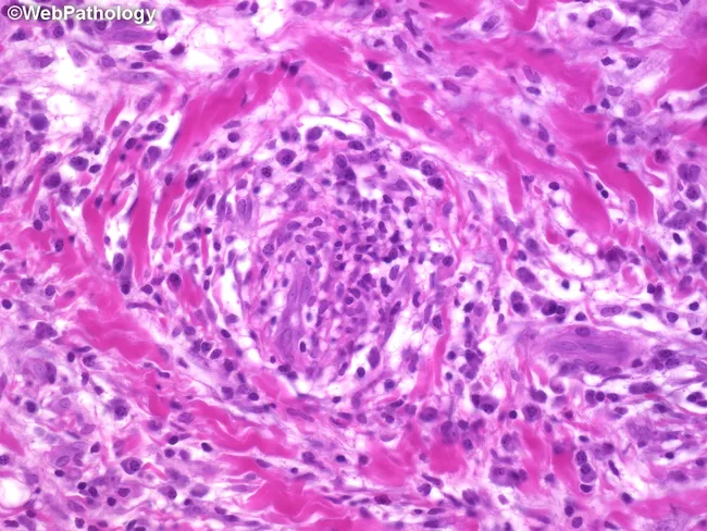 Syphilitic Lymphadenitis