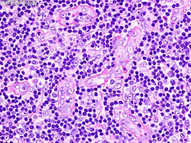 Castleman Disease: Hyaline-Vascular Type