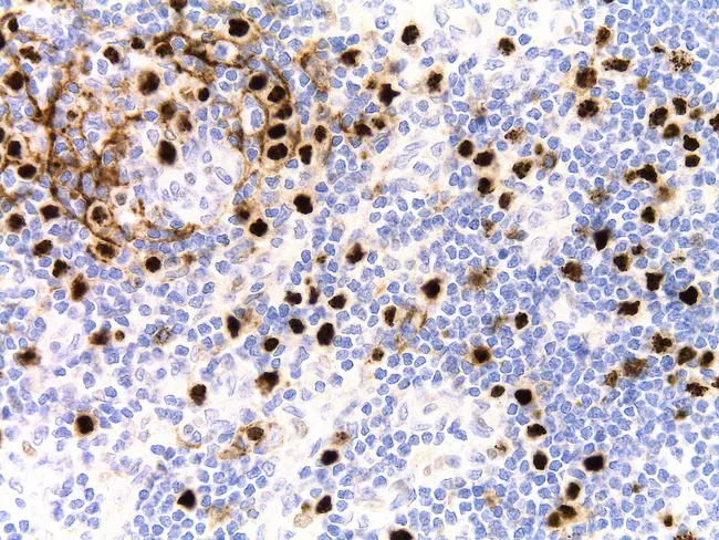 Castleman Disease: Plasma Cell Type