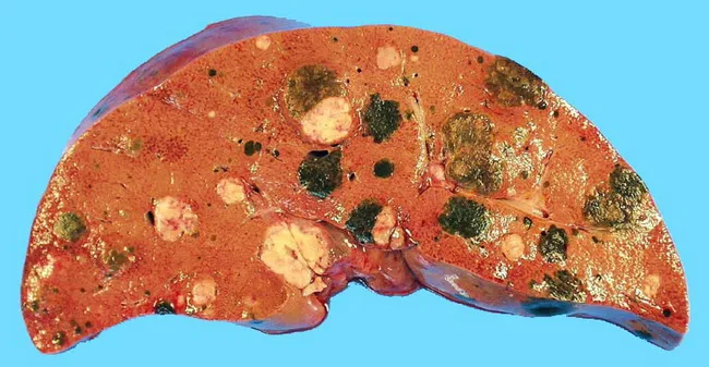 metastatic melanotic sarcoma Frontiers Melanoma recurrence or something else?