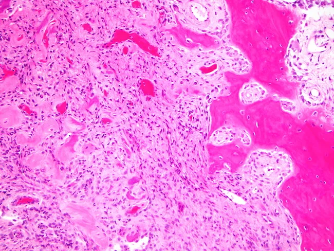 Peripheral Ossifying Fibroma Histology Diagram