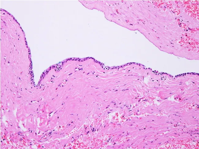 Choledochal Cyst Microscopic Features