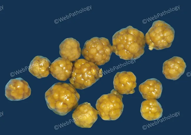 Cholesterol Gallstones : Appearance