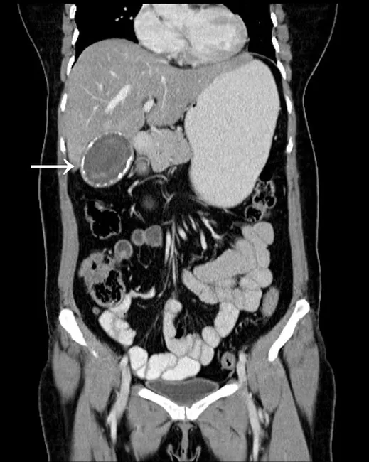 Porcelain Gallbladder : Imaging