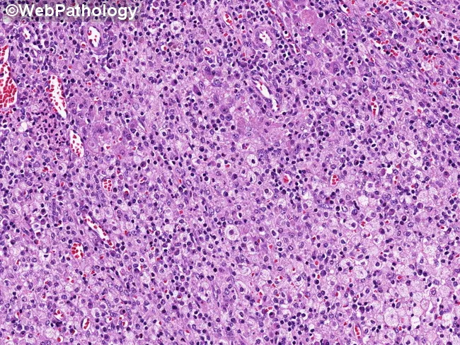 Xanthogranulomatous Cholecystitis