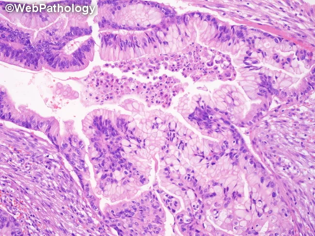 Gallbladder ICPN : Gastric Foveolar Phenotype