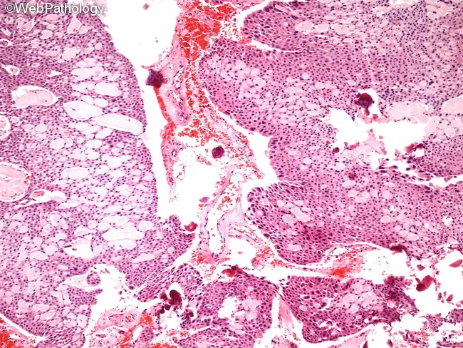 Pindborg Tumor : Microscopic