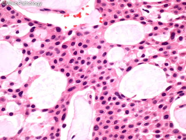 Pindborg Tumor : Microscopic