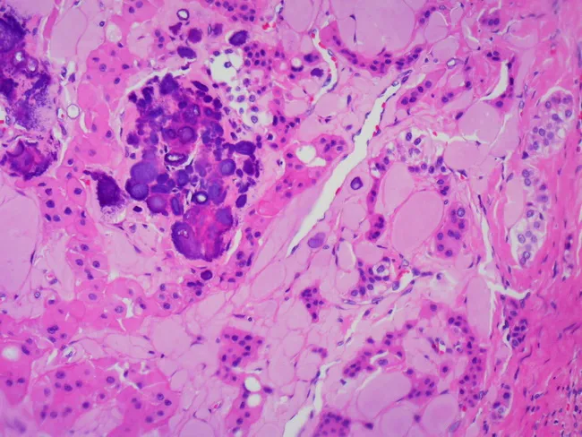 Pindborg Tumor : Microscopic
