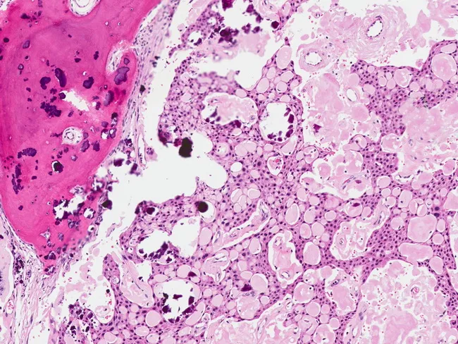 Pindborg Tumor : Microscopic
