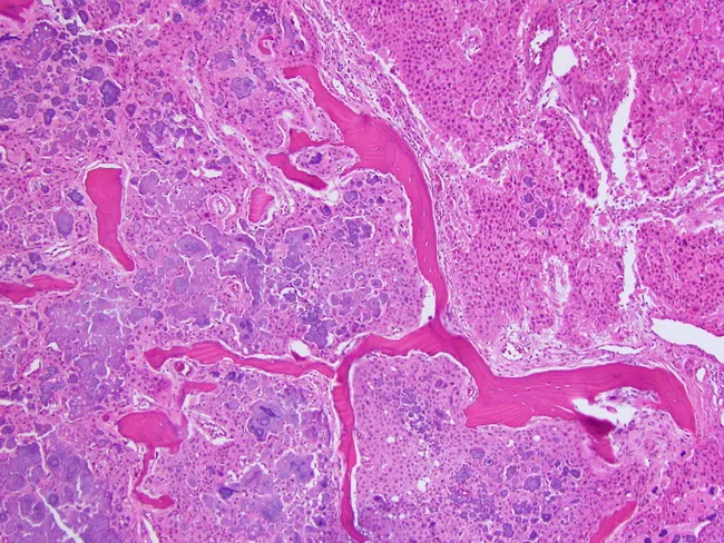 Pindborg Tumor : Treatment