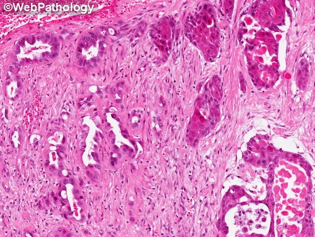 Adenosquamous Carcinoma of Gallbladder