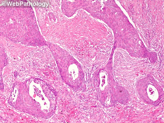 Adenosquamous Carcinoma of Gallbladder