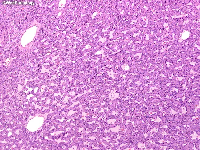 Acinar Cell CA