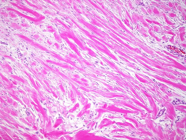 extra-abdominal-fibromatosis-desmoid-tumor