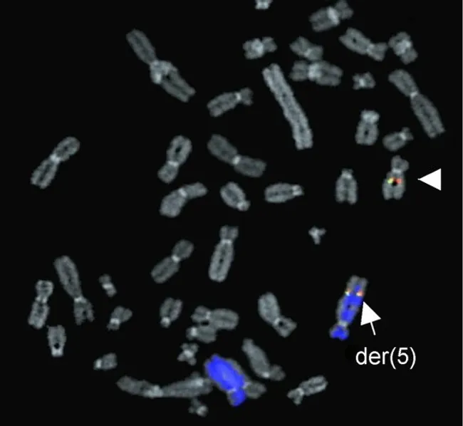 Lipoma : Cytogenetics