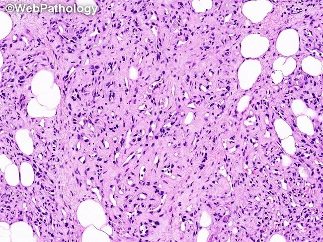 Angiolipoma : Microscopic Features
