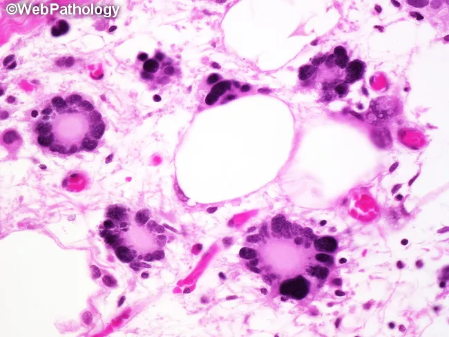 Pleomorphic Lipoma : Microscopic Features