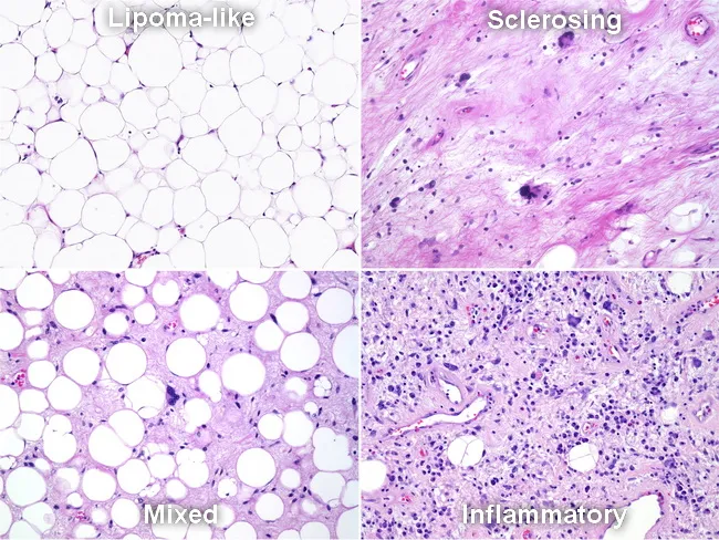 Atypical Lipomatous Tumor/Well-Diff Liposarcoma : Microscopic Patterns
