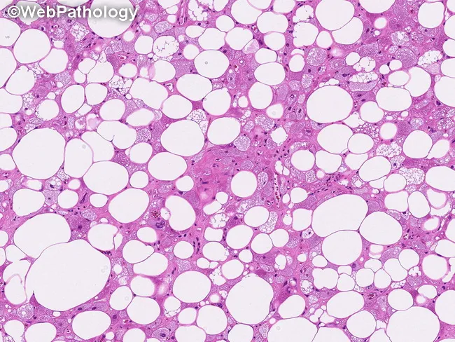 Atypical Lipomatous Tumor/Well-Diff Liposarcoma : Lipoma-like