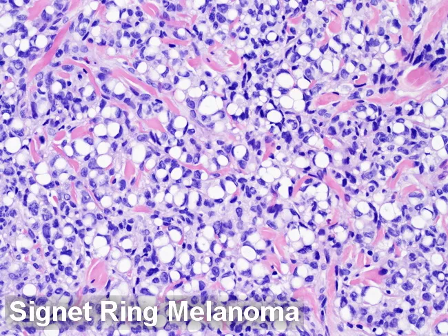 Atypical Lipomatous Tumor/Well-Diff Liposarcoma : Differential