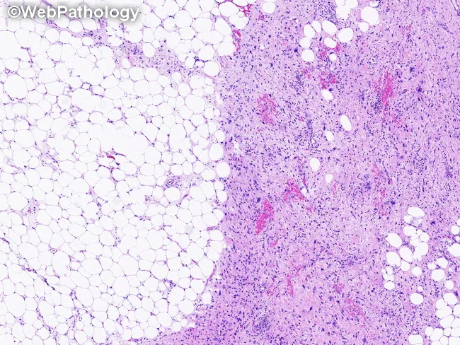 Atypical Lipomatous Tumor/Well-Diff Liposarcoma : Prognosis
