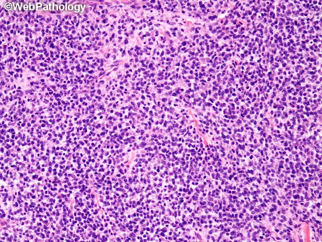 Embryonal Rhabdomyosarcoma