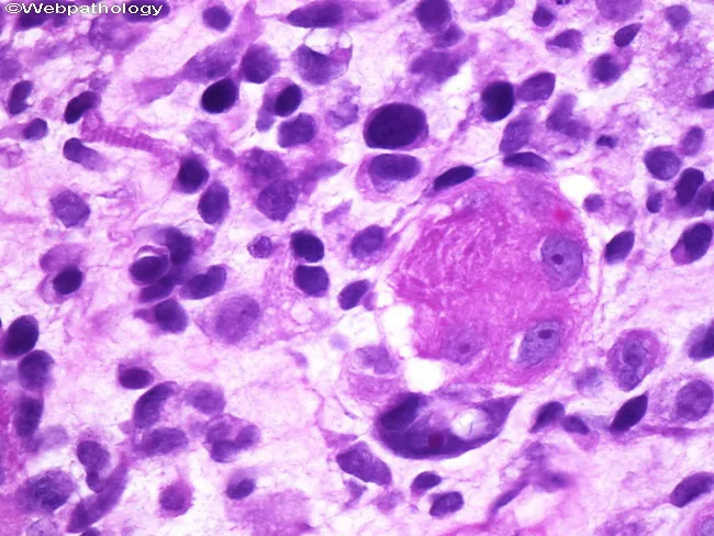 Embryonal Rhabdomyosarcoma