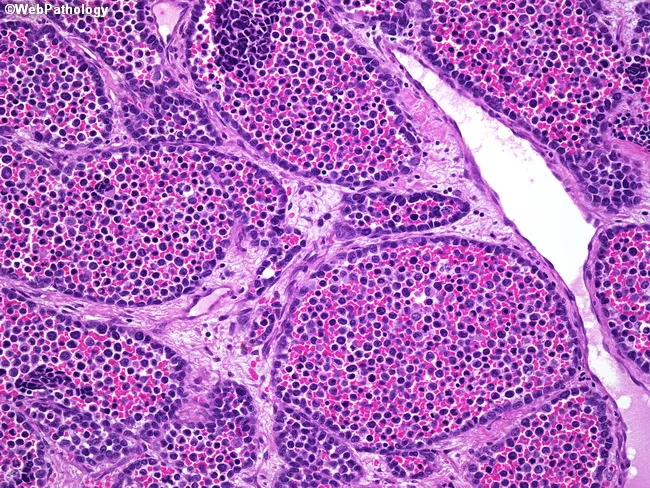 Alveolar Rhabdomyosarcoma : Microscopic