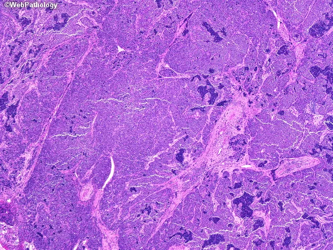 Alveolar Rhabdomyosarcoma - Solid pattern