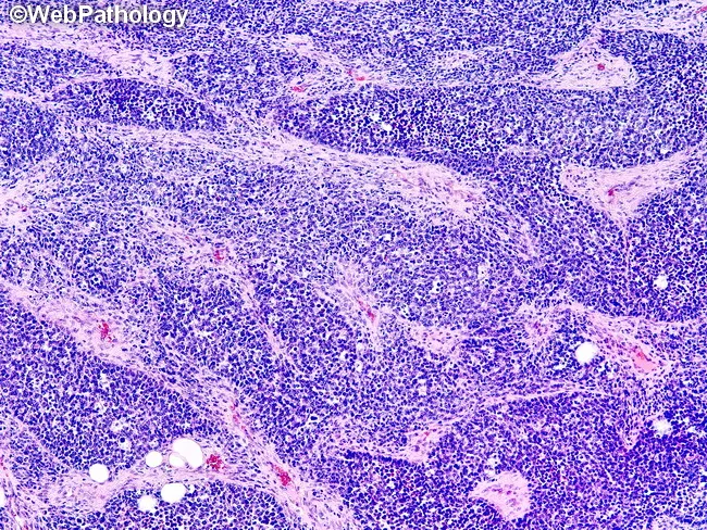 Fusion-negative Alveolar Rhabdomyosarcoma