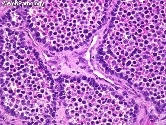 Alveolar Rhabdomyosarcoma