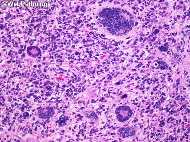 Alveolar Rhabdomyosarcoma