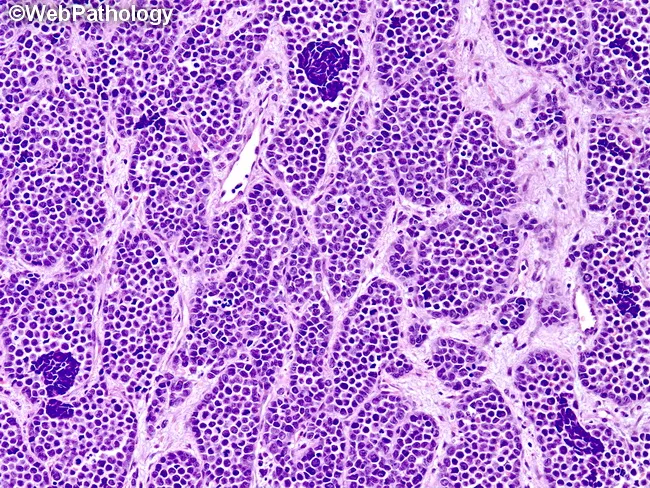 Alveolar Rhabdomyosarcoma