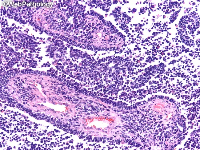 Alveolar Rhabdomyosarcoma