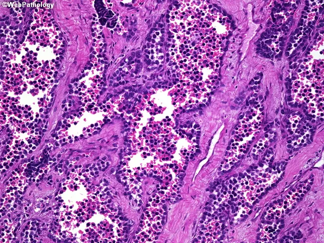 Alveolar Rhabdomyosarcoma