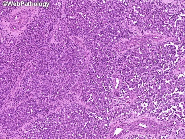 Alveolar Rhabdomyosarcoma