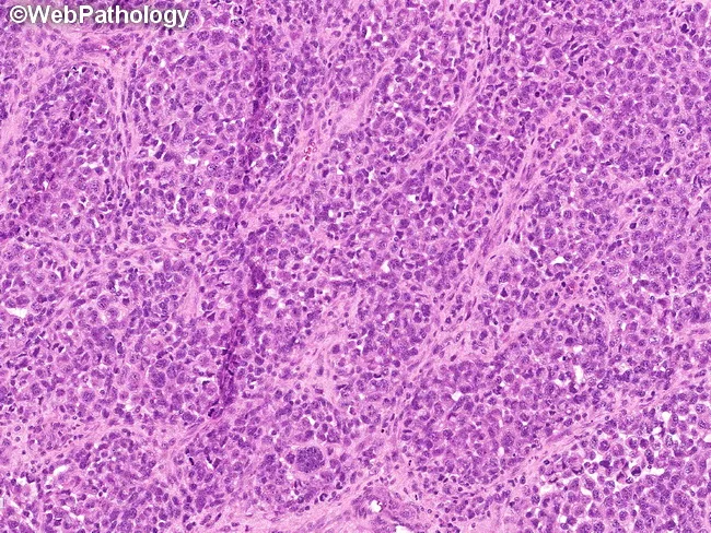 Alveolar Rhabdomyosarcoma