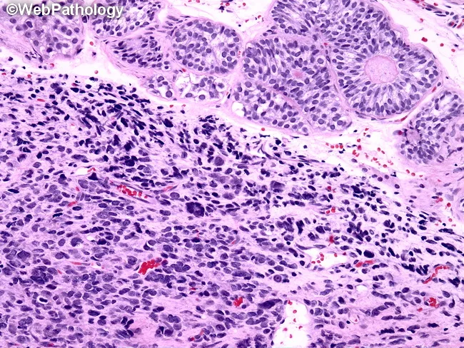 Alveolar Rhabdomyosarcoma