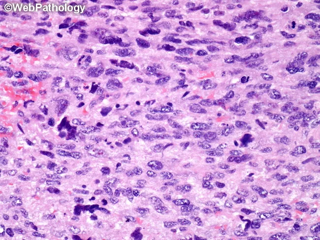 Pleomorphic Rhabdomyosarcoma : Differential