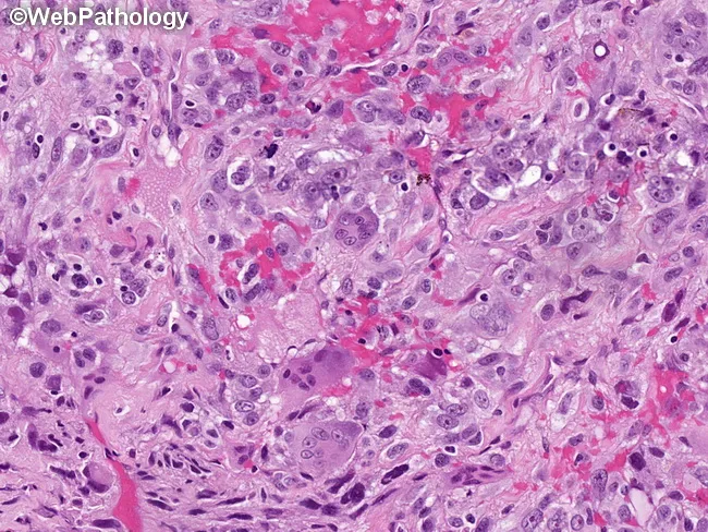 Pleomorphic Rhabdomyosarcoma