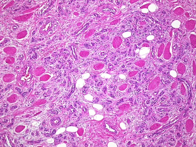 capillary hemangioma pathology outlines