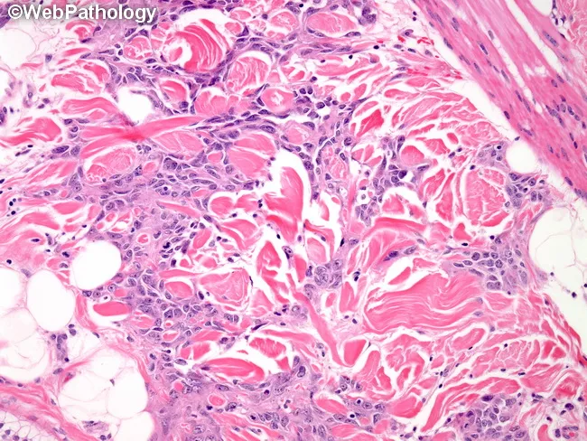 Cutaneous Angiosarcoma