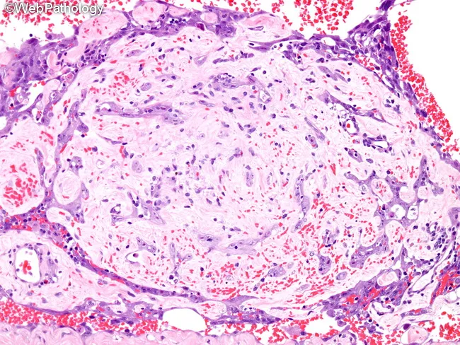 Cutaneous Angiosarcoma : Treatment
