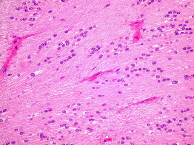 Tanycytic Ependymoma