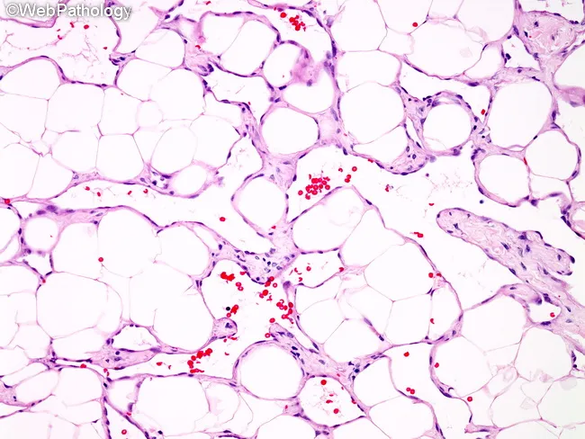 Primary Breast Angiosarcoma